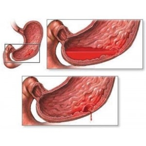 Ulcer gastroduodenal